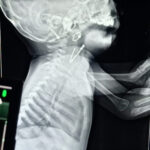 घशामध्ये अडकलेली सेफ्टी पिन काढण्यात यश